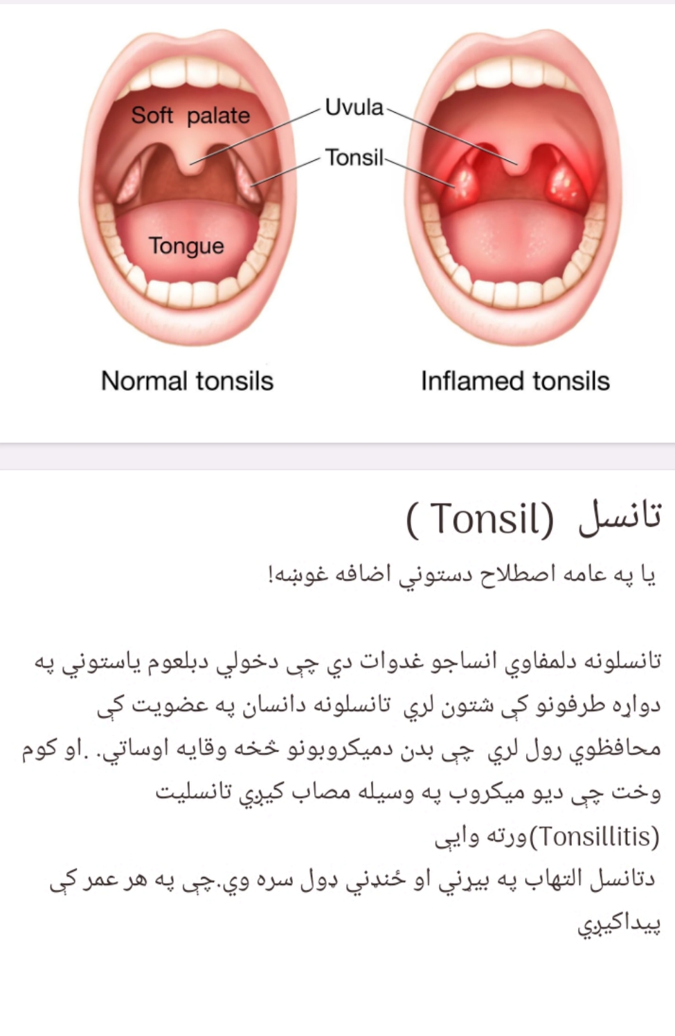 د تانسل ناروغۍ معرفت او درملنه یې